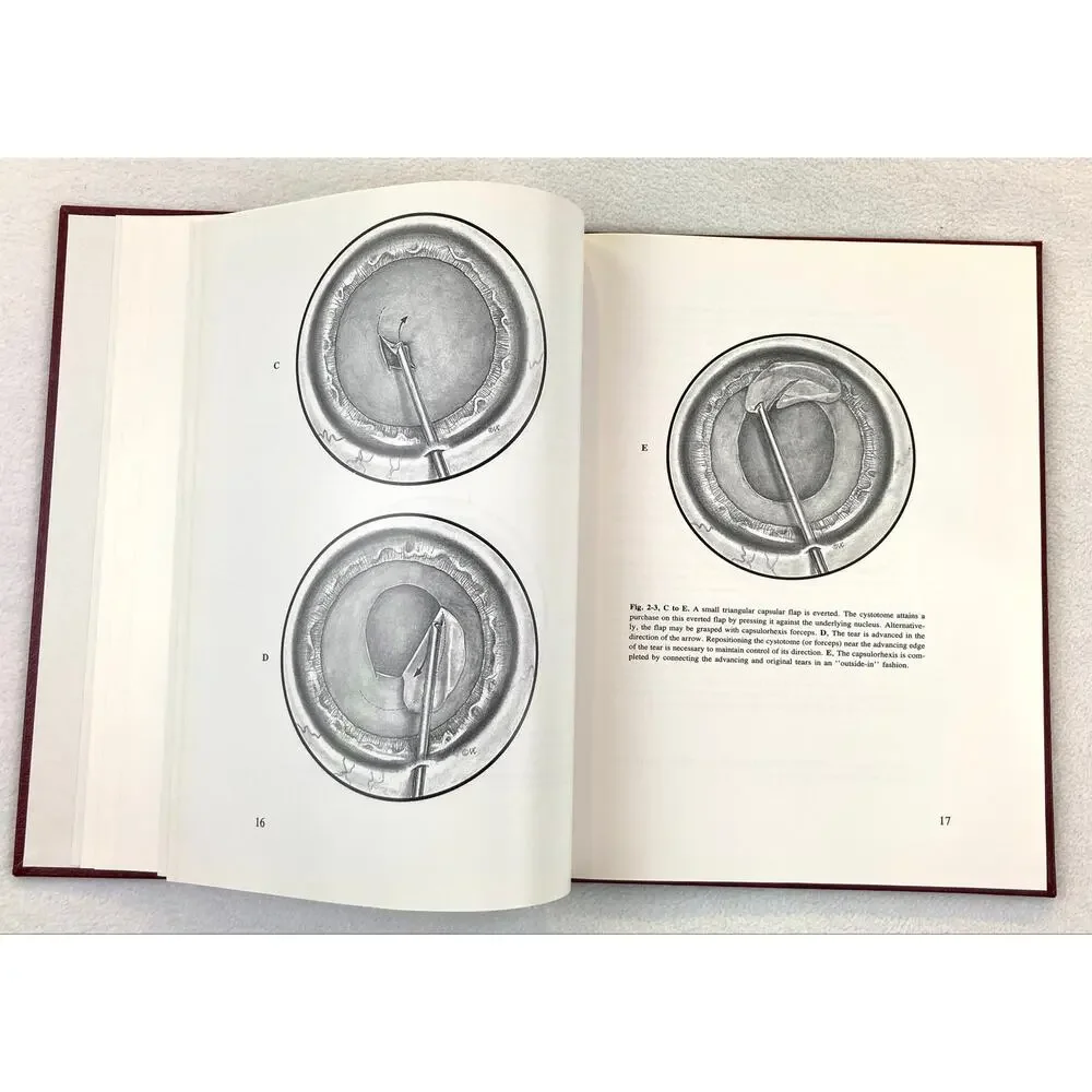 The Stereoatlas of Phacoemulsification and IOL Implantion Vintage 1990